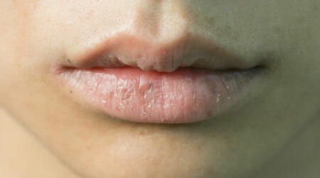 4 common mistakes that make one&#8217;s lips dry and damaged