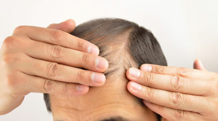 Hair loss – Its symptoms and causes