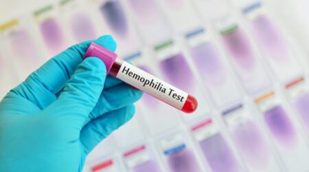 4 best foods for hemophilia