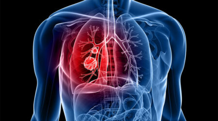 5 cities with the highest rates of lung cancer