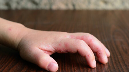 8 first-line treatment options for atopic dermatitis in infants