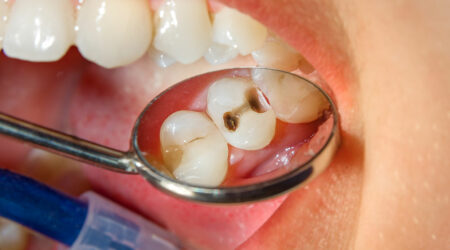 8 signs of dental issues due to high sugar intake